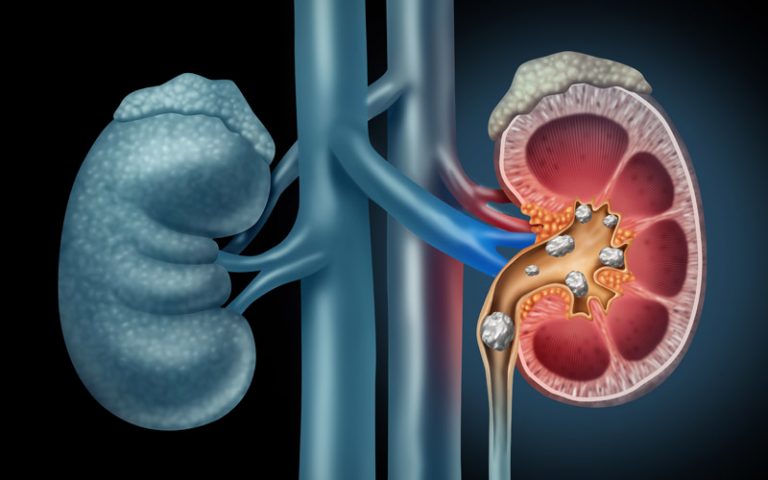 Kidney Stones general health Urology Clinics of North Texas