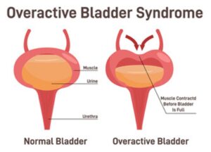 Normal bladder versus overactive bladder.