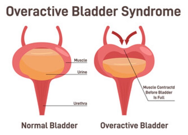 Your Overactive Bladder Matters - Urology Clinics of North Texas