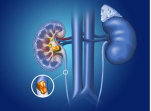 Illustration depicting what kidney stones look like in the body.
