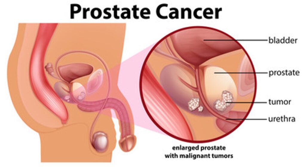 Cartoon anatomy of prostate cancer.